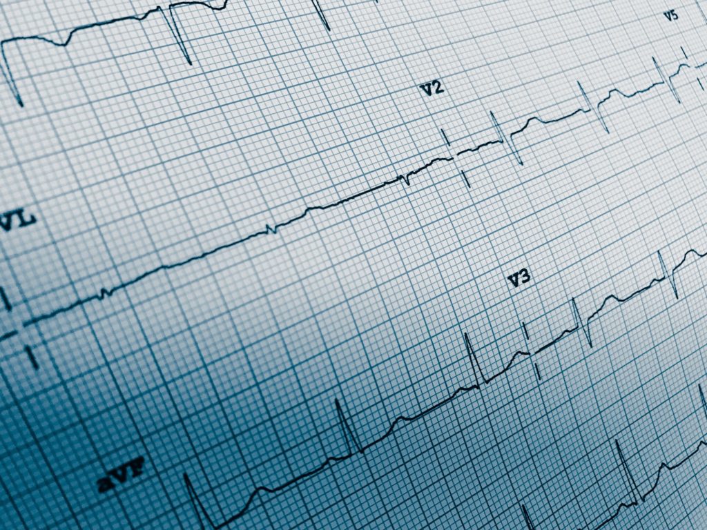 Close up of an electrocardiogram in paper form. Medical and health care concept for background.